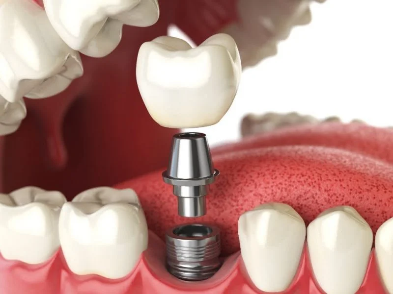 Racine artificielle - Implant dentaire