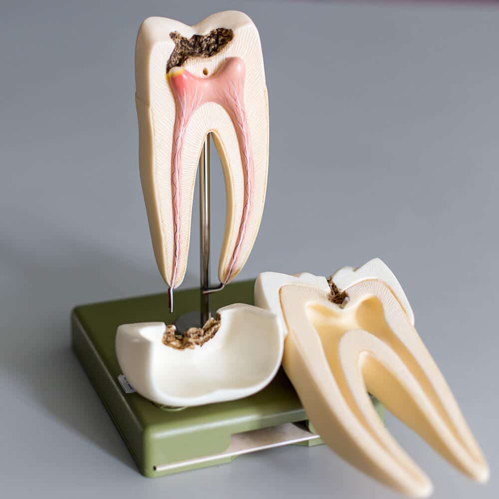 Traitement endodontique - Sauvegarde dentaire