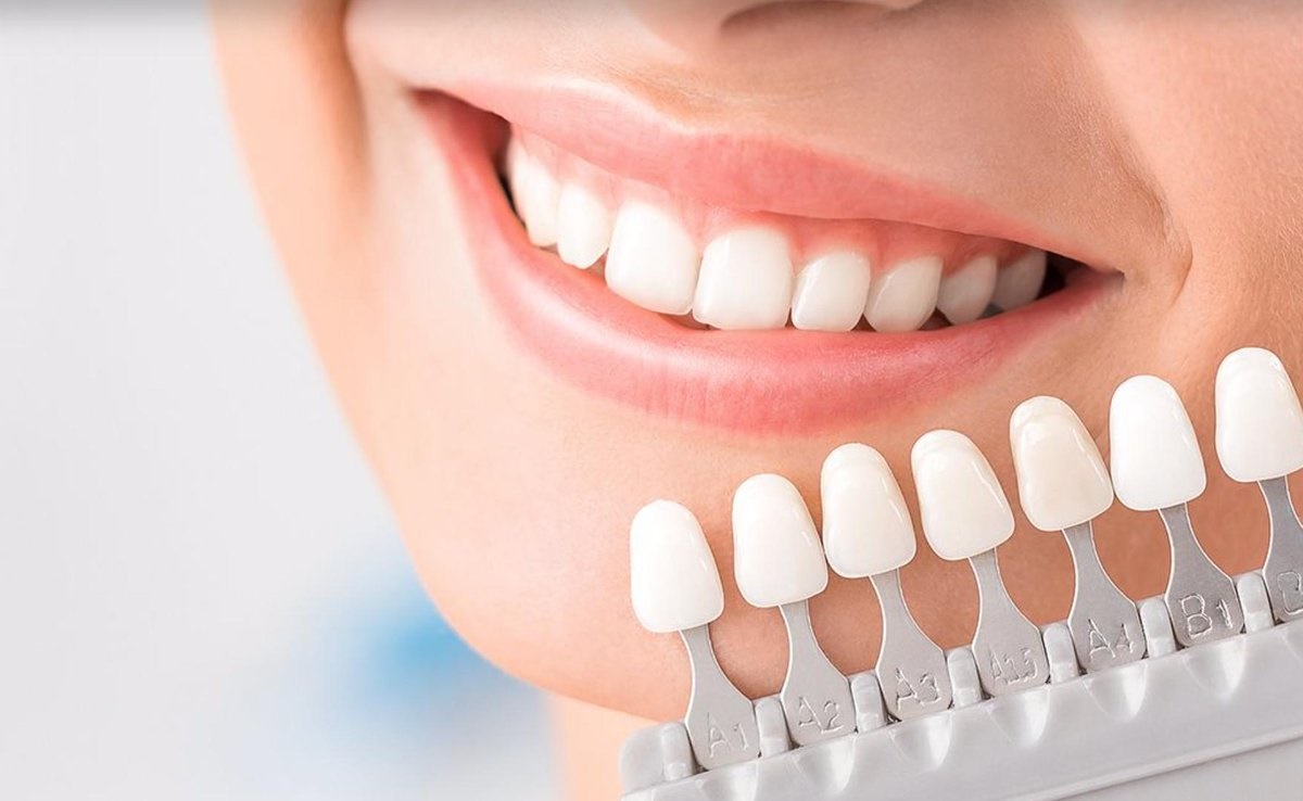 Facettes dentaires - Résultat Hollywood Smile